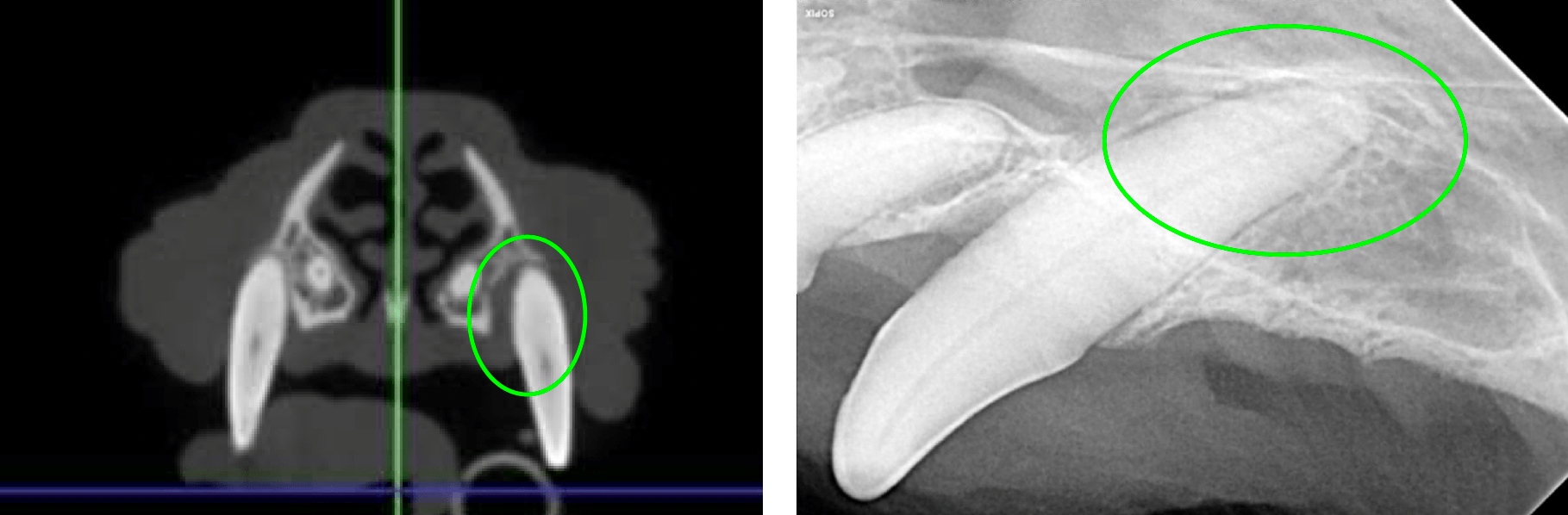 Bone Loss affecting uppler left canine tooth
