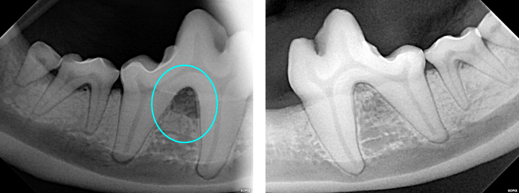 Both sides of the lower right 4th premolar - Furcation exposure through and through - Bone loss