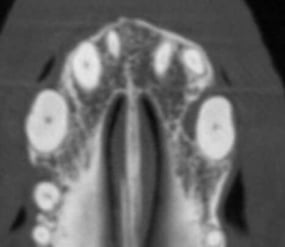 CT Image of infrabony pocket 204 