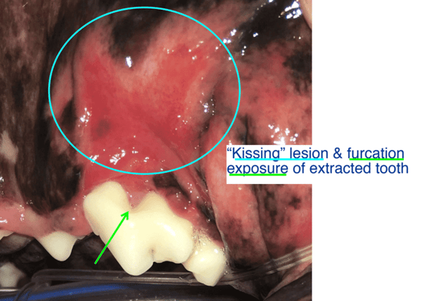 -Kissing- lesion & furcation exposure of extracted tooth