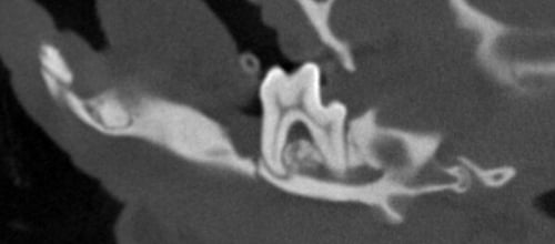 CT slice with insufficient bone to be able to repair