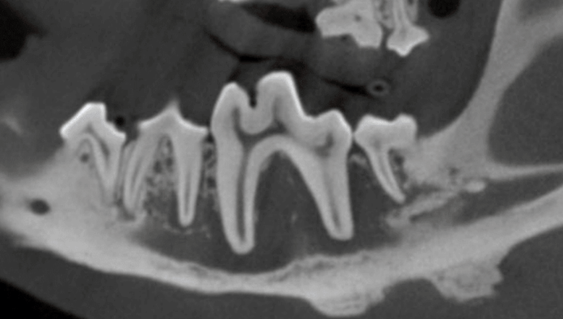 CT Cross section of disease