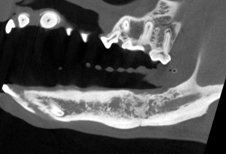 CTFollow Up - Cross section of the prior disease site, sagittal plane, now with significant healing