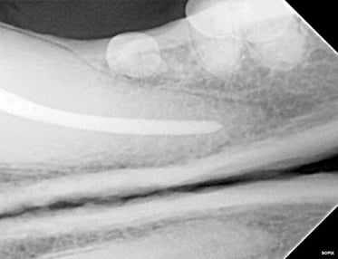 Radiograph of Final fill of RCT - Apex