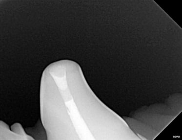 Radiograph of Final restoration of RCT - Crown 