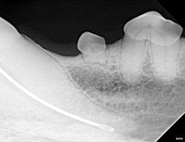 Radiograph showing master file size during RCT