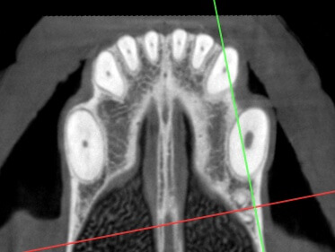 CT Image comparing upper canines root canals 104 vs discolored 204