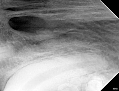 Radiograph before RCT - apex