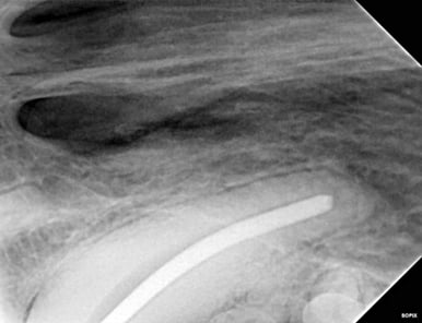 Radiograph of dry fit of gutta percha during RCT