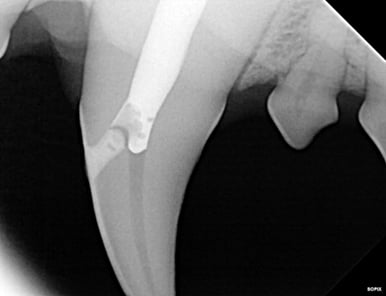 Radiograph of final fill of RCT - crown