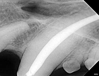 Radiograph of final fill of RCT - middle