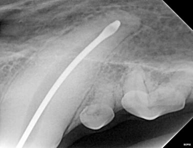 Radiograph of master file during RCT