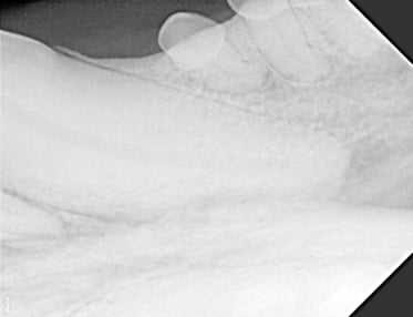 Apex radiograph before RCT