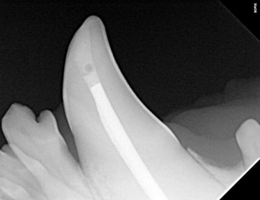 Final fill and Restoration of Crown RCT