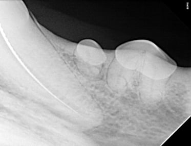 Working length radiograph during RCT